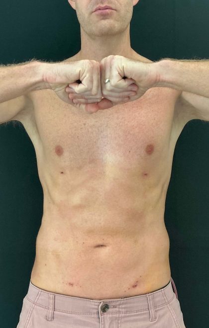 Liposuction Before & After Patient #4574