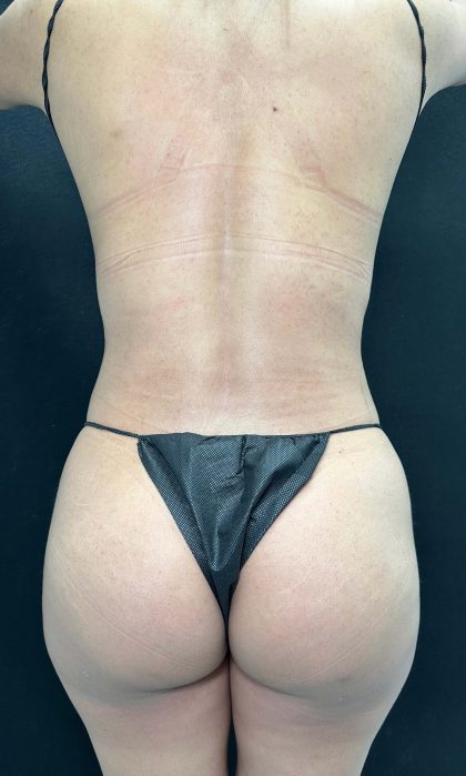 Brazilian Butt Lift Before & After Patient #4577