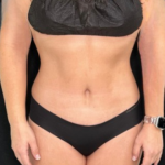 Tummy Tuck Before & After Patient #4353