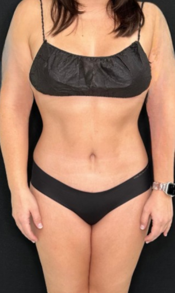 Tummy Tuck Before & After Patient #4353