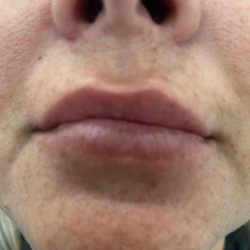 Filler Before & After Patient #4415