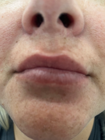 Filler Before & After Patient #4415