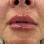 Filler Before & After Patient #4415