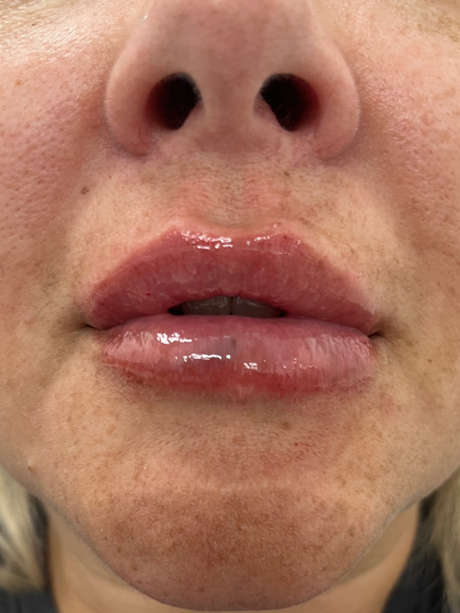 Filler Before & After Patient #4415