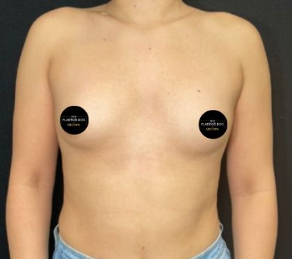 Breast Augmentation Before & After Patient #4473