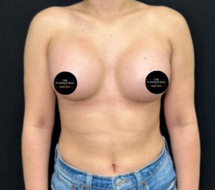 Breast Augmentation Before & After Patient #4473
