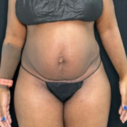 Tummy Tuck Before & After Patient #4355