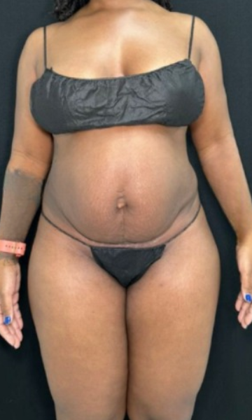 Tummy Tuck Before & After Patient #4355