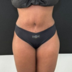 Tummy Tuck Before & After Patient #4355