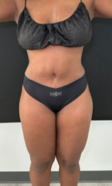 Tummy Tuck Before & After Patient #4355
