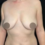 Breast Lift Before & After Patient #4474