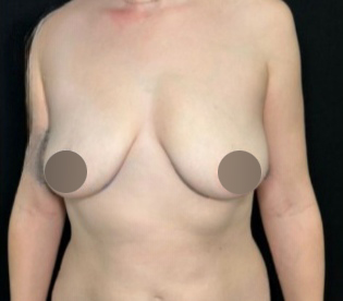 Breast Lift Before & After Patient #4474