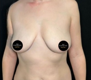 Breast Augmentation Before & After Patient #4474