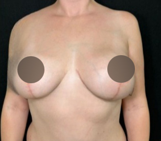 Breast Lift Before & After Patient #4474