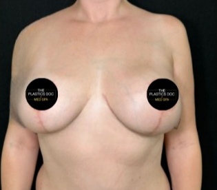 Breast Augmentation Before & After Patient #4474