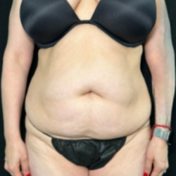 Tummy Tuck Before & After Patient #4356