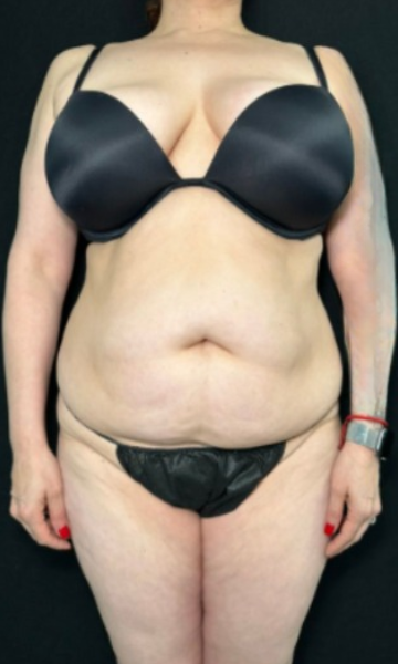 Tummy Tuck Before & After Patient #4356