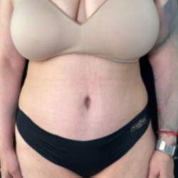 Tummy Tuck Before & After Patient #4356