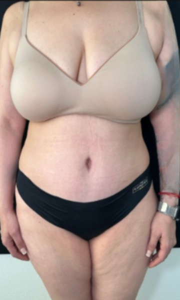Tummy Tuck Before & After Patient #4356