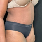 Tummy Tuck Before & After Patient #4357