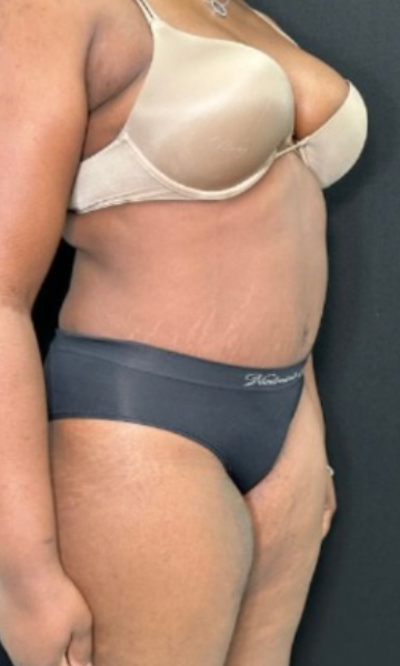 Tummy Tuck Before & After Patient #4357