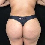 Aveli Before & After Patient #4450