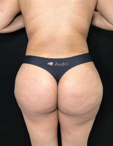 Aveli Before & After Patient #4450