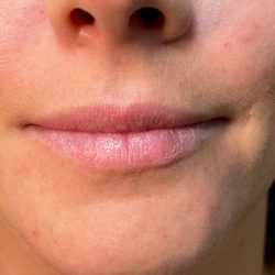 Filler Before & After Patient #4416