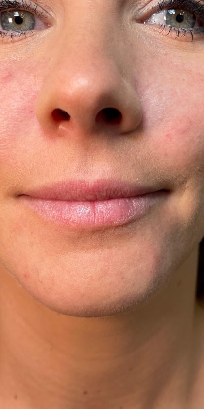 Filler Before & After Patient #4416