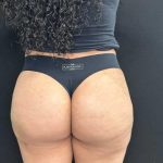 Aveli Before & After Patient #4450