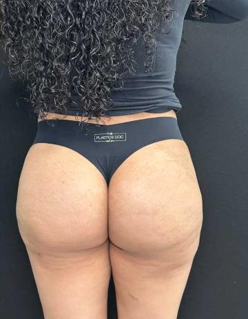 Aveli Before & After Patient #4450