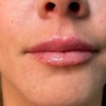 Filler Before & After Patient #4416