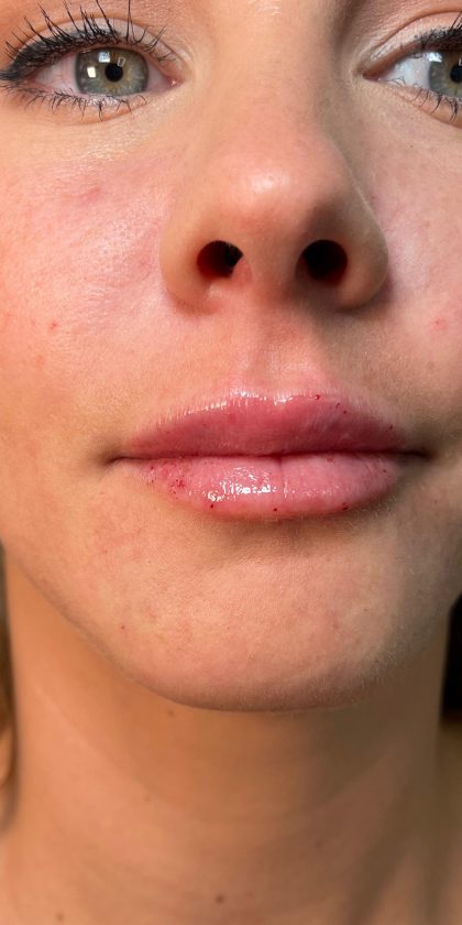 Filler Before & After Patient #4416