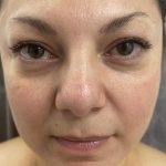 Filler Before & After Patient #4417