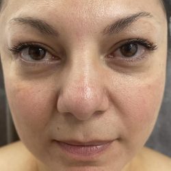 Filler Before & After Patient #4417