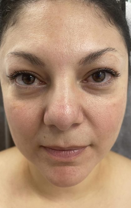 Filler Before & After Patient #4417
