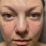 Filler Before & After Patient #4417