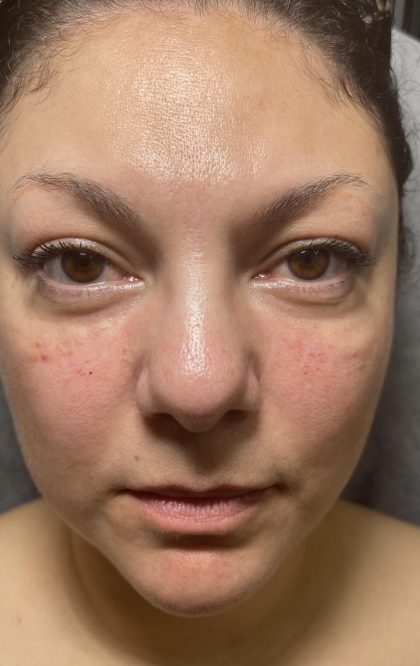 Filler Before & After Patient #4417
