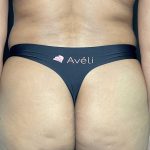 Aveli Before & After Patient #4453