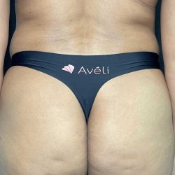 Aveli Before & After Patient #4453