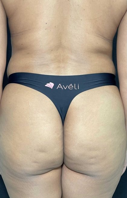 Aveli Before & After Patient #4453