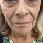 Filler Before & After Patient #4418