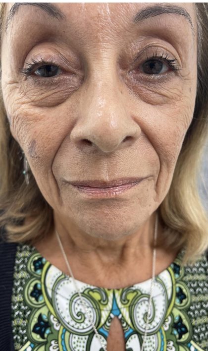 Filler Before & After Patient #4418