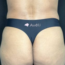 Aveli Before & After Patient #4453