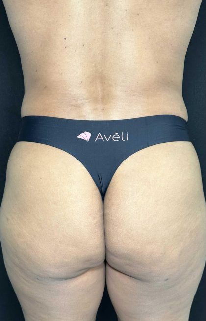 Aveli Before & After Patient #4453