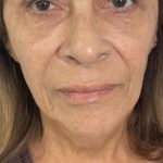 Filler Before & After Patient #4418