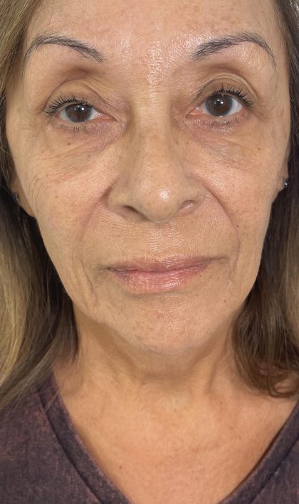 Filler Before & After Patient #4418