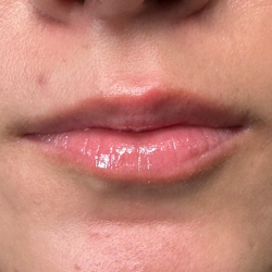 Filler Before & After Patient #4419