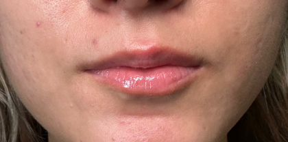 Filler Before & After Patient #4419