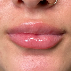 Filler Before & After Patient #4419